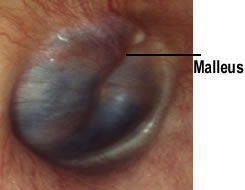 Glomus tympanicum tumor