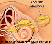Acoustic neuroma in the internal auditory canal