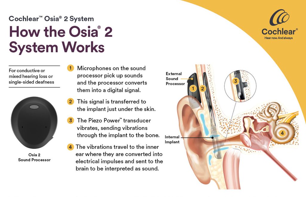 Ear Deaf Surgery Ear Deaf Surgery