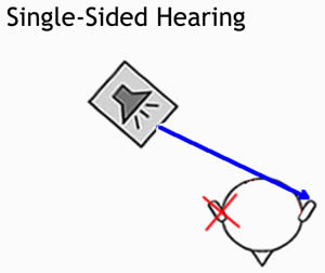 Single Sided Hearing Image