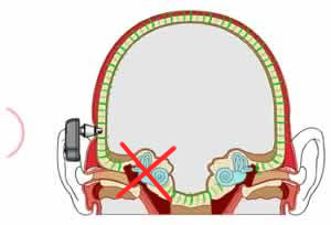 Baha and Single Sided Deafness image