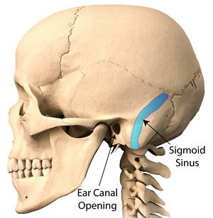Sigmoid Sinus Image