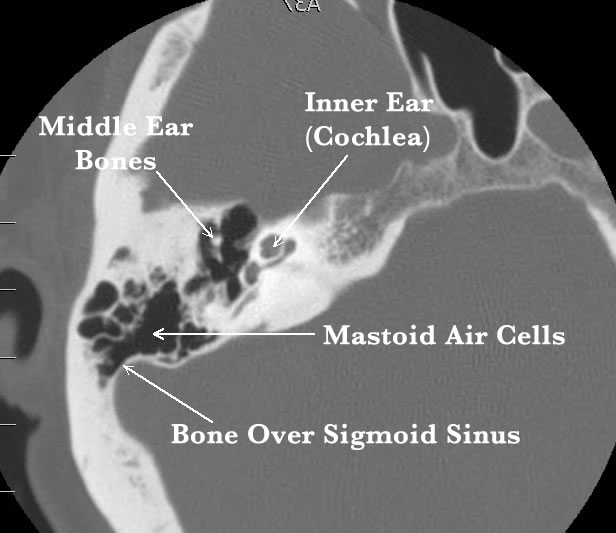 CT image of sigmoid sinus