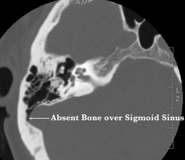 CT of dehiscent sigmoid sinus